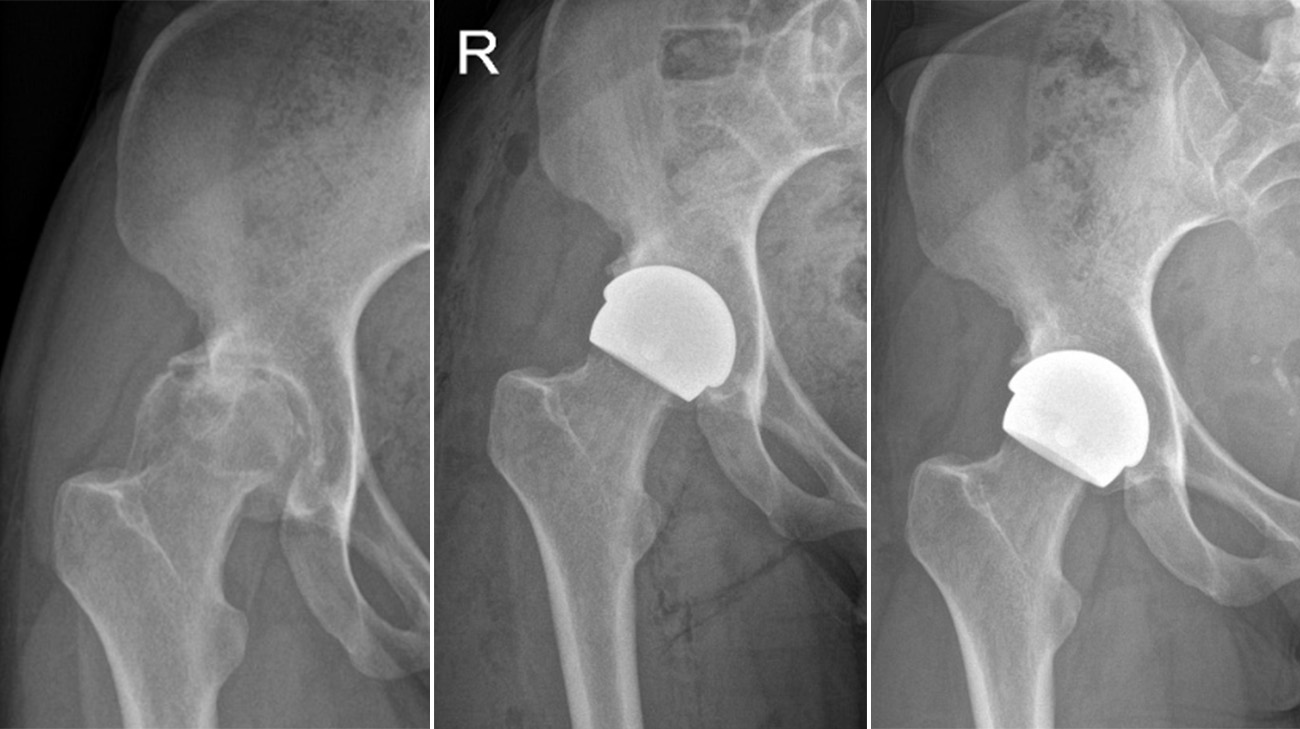 Scans showing Georgina's hip before and after surgery