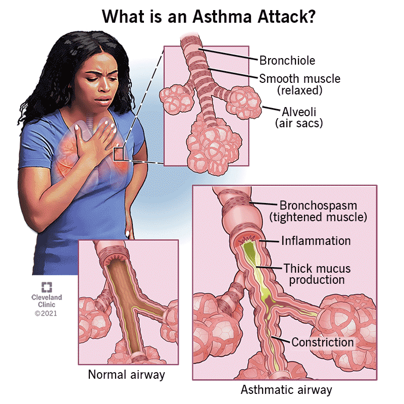 Open airway versus airway during and asthma attack, which shows tightened muscles, inflammation and excess mucus.